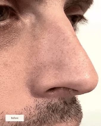 Nose Patches (8x Per box)